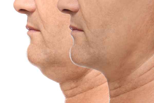 HIFU - Breakthrough in Anti - ageing 2 hifu results Burgess Hill