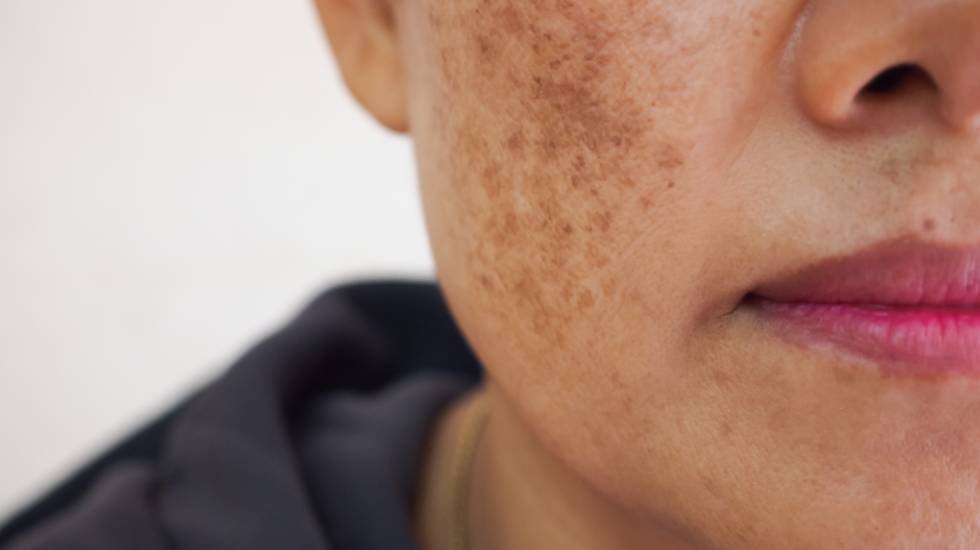 Ephelides Treatment Burgess Hill