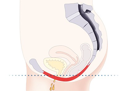 Pelvic-Floor Muscle Repair 5 Pelvic floor muscles Burgess Hill