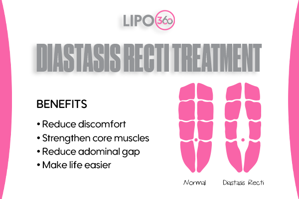 Revolutionising Muscle Repair: The Power of LIPO360 Body Sculpt Post-Injury 5 diastasis recti treatment Burgess Hill
