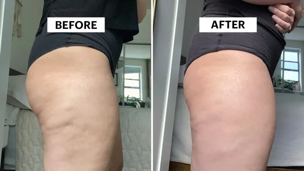 Do Toning Exercise Burgess Hill Really Tackle Cellulite?