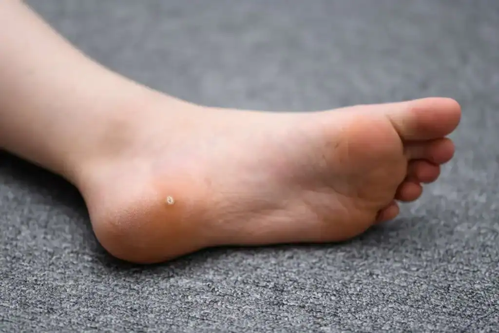 Cryotherapy For Warts And Also Verrucas 2 Image of verruca on the bottom of the foot that able to be treated with Cryotherapy Burgess Hill