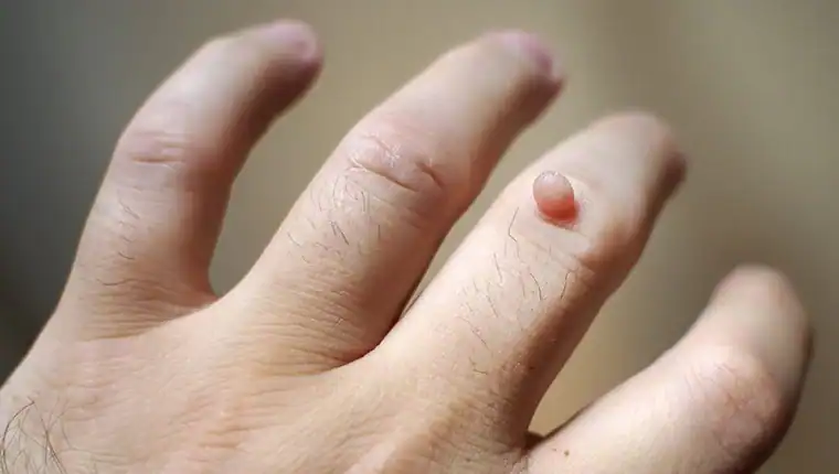Image of blemish that Cryotherapy Burgess Hill can remove with Lipo 360.