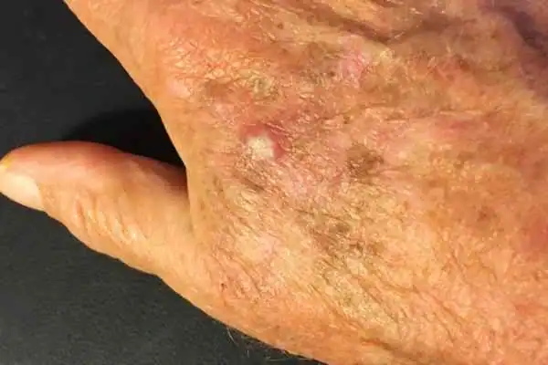 Image of Actinic keratoses Burgess Hill on a person hand