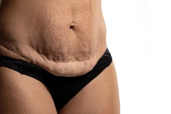 The science behind skin tightening Burgess Hill picture of a woman's sagging skin on the stomach